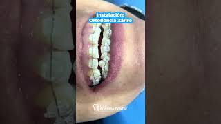 Clinica Sonrisa Dental  Instalacion Ortodoncia Zafiro [upl. by Ardnic449]