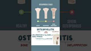 Bone Health Common Diseases You Should Know🦴 youtubeshorts information factshealth disease [upl. by Vories657]