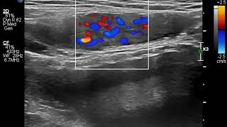 Round ligament varices [upl. by Mancino]