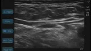 Femoral Nerve Ultrasound [upl. by Eon]