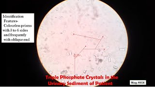 Triple Phosphate Crystals in Urine [upl. by Luckin]