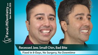 Recessed Jaw Small Chin Bad Bite Fixed in 8Days No Surgery [upl. by Ohcamac]