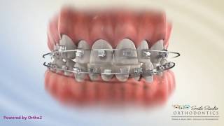 Damon Posterior Crossbite   Orthodontic Treatment [upl. by Haas]