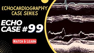 ECHO CASE 99  Echocardiography for Beginners  M Mode Echocardiogram [upl. by Larine]