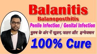 Balanitis  How to Cure Balanitis  पुरुष के अंग में सूजन जलन और इन्फेक्शन का इलाज [upl. by Rolfston491]