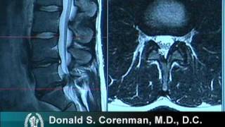 How to Read a MRI of a Lumbar Herniated Disc  Lower Back Pain  Colorado Spine Surgeon [upl. by Siulesoj]