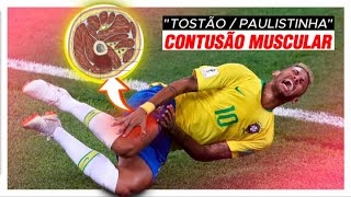 💢 CONTUSÃO MUSCULAR quotPaulistinhaTostãoquot  Anatomia de Lesões Esportivas  Daniel Bohn [upl. by Lahcym]