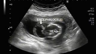 Ultrasound Video showing encephalocele [upl. by Riobard]