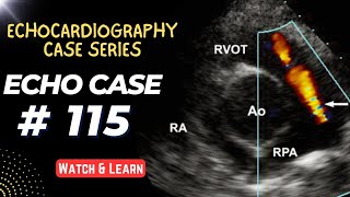 ECHO CASE 115  Echocardiography Spot Diagnosis Case Series [upl. by Waterer]