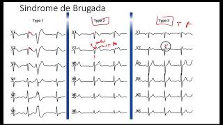 Sindrome de Brugada [upl. by Temp]