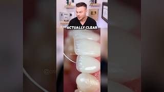 How to Get Veneers That DON’T Ruin Your Real Teeth [upl. by Ahsaele]