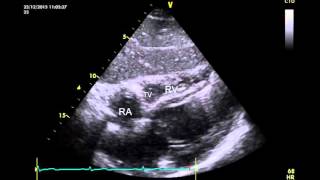 Subcostal 4 chamber view of a normal heart [upl. by Durr]