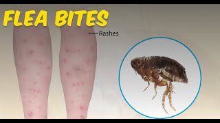 Flea Bites Everything you Need to Know [upl. by Ytrebil]