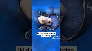 dentist thedentalviews dentalprocedure dentalpractice dentaltreatment dentistry [upl. by Enilemme]