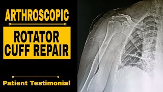 ARTHROSCOPIC ROTATOR CUFF REPAIR [upl. by Nainatrad]