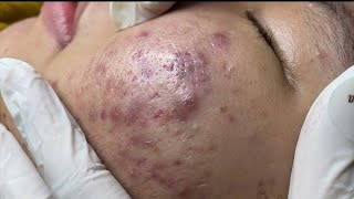 loan nguyen acne treatment amp Blackheads removal [upl. by Audsley928]