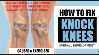 KNOCK KNEES OR GENU VALGUM FOR RUNNERS [upl. by Boyd191]