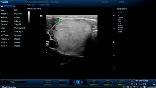 4th tirads score thyroid nodule Diagnostic ultrasound cases [upl. by Nimajaneb]