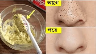 নাকের উপর সকল কালো শাল  ব্লাকহেডস  দূর করার উপায়  How To Remove Blackheads Naturally At Home [upl. by Roderick]