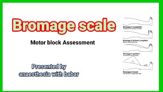 Bromage scale  motor block Assessment anaesthesiawithbabar2576 short [upl. by Rodge471]