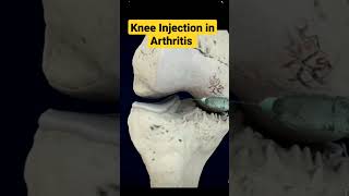 How Knee Injection is Helpful In Arthritis ✓ arthritis kneearthritis kneepain osteoarthritis [upl. by Hausner536]