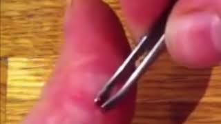 Splinter removal Video in Thumb [upl. by Attennhoj832]