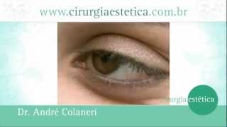 Cirurgia Plástica das Pálpebras  Blefaroplastia Dr André Colaneri [upl. by Swec]