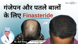 गंजेपन और पतले बालों के लिए Finasteride  FINASTERIDE क्या होता है  Right Dose Of Finasteride [upl. by Heidi]