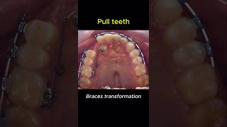 Braces change your teeth for better braces orthodontist dentist [upl. by Barthel]