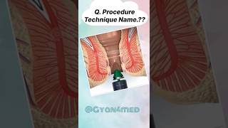 Procedure technique name [upl. by Canter]