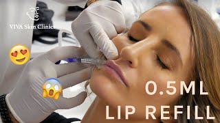 05ML LIP REFILL  NATURAL LOOKING FULL LIPS  LIP FILLERS  VIVA Skin Clinics [upl. by Otit]