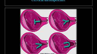 Obstetric US 6 Cervix [upl. by Rennug930]