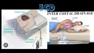 intercostal drainagerecurrent plueral effusionmbbsprocedure medicose Sudarshanlipane17 ⛑️⛑️🩺 [upl. by Asiral181]