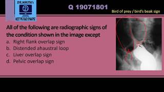 Sigmoid volvulus  Radiology signs [upl. by Nobe]