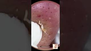 Blackheads Removal  Acne Treatment and Very Satisfying Satisfying Pimple pop blackheads [upl. by Aehc]