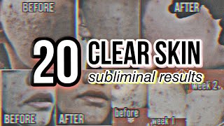 TOP 20 EXTREME CLEAR SKIN Subliminal Results ❗ [upl. by Bollen]