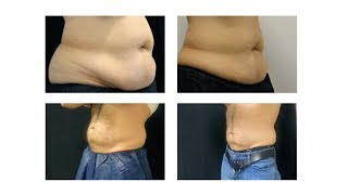 Coolsculpting Fat Freezing Treatment  Does it work [upl. by Power896]