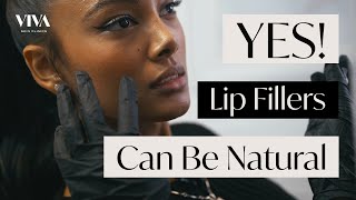 Natural Lip Filler Procedure 👄 Before amp After of Subtle and Delicate Lip Modification [upl. by Anifares38]