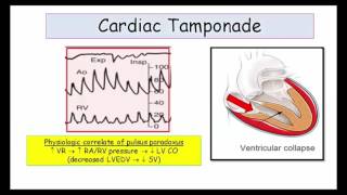 12DaysinMarch Tamponade and Constrictive Pericarditis for USMLE Step One Part II [upl. by Wearing]