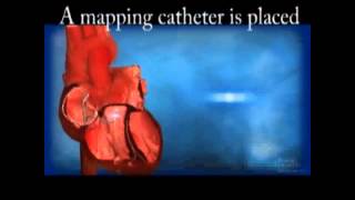 Ventricular Tachycardia VT Ablation [upl. by Latt907]