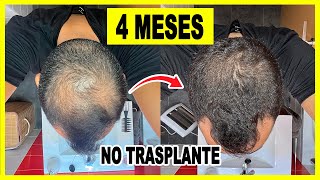 🤫 Recupero el Pelo en 4 meses  SIN trasplante capilar en ESPAÑA [upl. by Nevet]