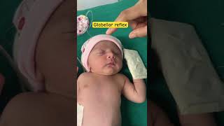 Reflex examination physiology  palmar reflex in newborn  Glabellar reflex in newborn  youtube [upl. by Edroi412]