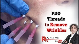 PDO Threads to Smooth Wrinkles [upl. by Rodnas487]