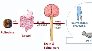 Poliomyelitis medicalsurgicalnursing 2gnm 2nd Gnm [upl. by Campagna]