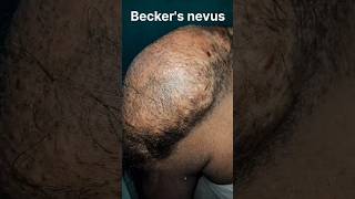 Beckers nevus with smooth muscle hamartoma 😱 shorts skincare shortsfeed viral [upl. by Bocoj]