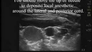 UltrasoundGuided Infraclavicular Block [upl. by Akinihs]