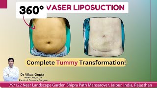 Transform Your Tummy with 360° VASER Liposuction  Dr Vikas Gupta  Nv Aesthetics amp Dental Hub [upl. by Nairdna71]