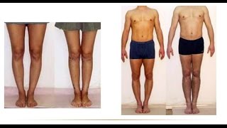 How To Straighten Bow Legs How To Correct Knock Knees Knock Knees Surgery Fix Bow Legs [upl. by Nodrog]