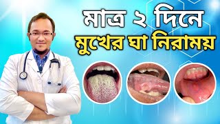 মুখের ঘা দূর করার উপায়mukhe gha hole ki korboমুখে ঘা হলে কি করবেনমুখের ঘা সারানোর উপায় [upl. by Welton]