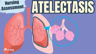 Atelectasis Pathophysiology and Nursing Assessment [upl. by Elleiand]